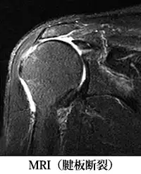 腱板断裂（MRI）