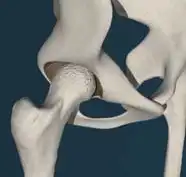 骨頭を切除し、大腿骨の内側を整えます