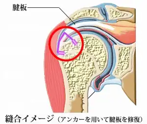 縫合イメージ図