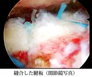 縫合した腱板（関節鏡写真）
