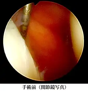 手術前（関節鏡写真）