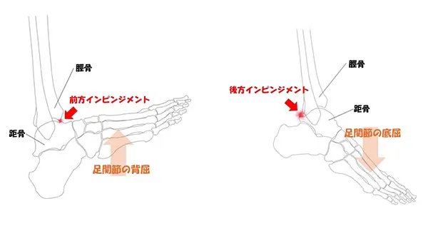 足関節前方インピンジメント症候群