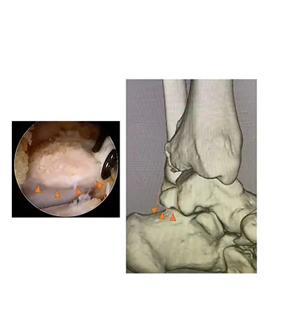 左：三角骨切除前の関節鏡と３D-CT