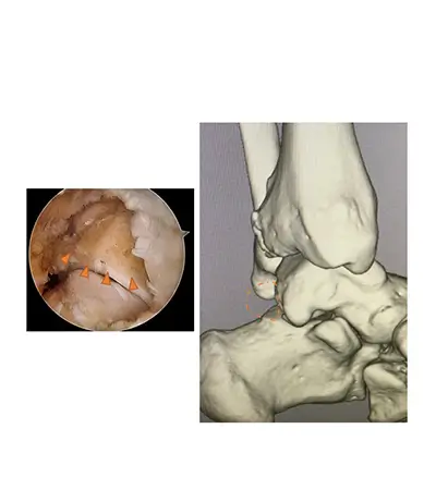 右：切除後の関節鏡と３D-CT