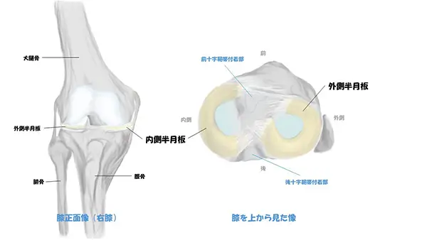 変性半月板損傷