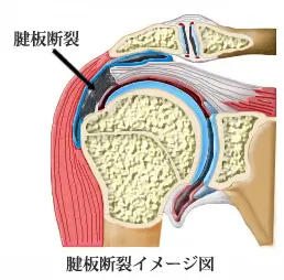 肩腱板断裂