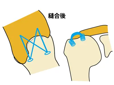 縫合後イラスト