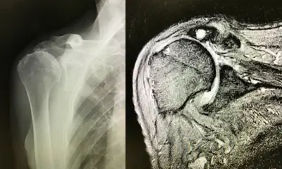 腱板断裂性関節症のX線像とMRI