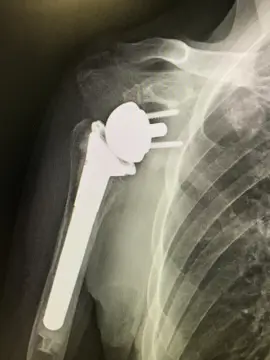 腱板断裂性関節症のX線像とMRI
