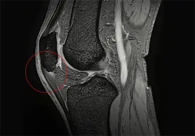 MRI：膝蓋骨下極の付着部での膝蓋腱症 