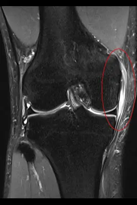 MRI：内側側副靭帯損傷