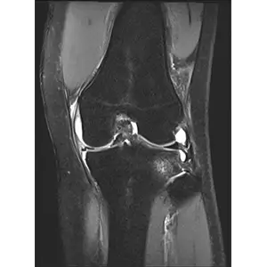 MRI（内側半月板のバケツの柄状断裂）