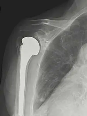 TSA（Total Shoulder Arthroplasty）解剖学的人工肩関節全置換術