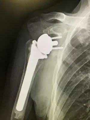 RSA（Reverse Shoulder Arthroplasty）リバース型人工肩関節全置換術