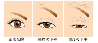 眼瞼下垂症
