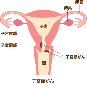 子宮頸がん
