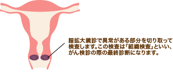 組織診