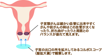 コルポスコープ