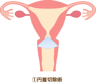 円錐切除術
