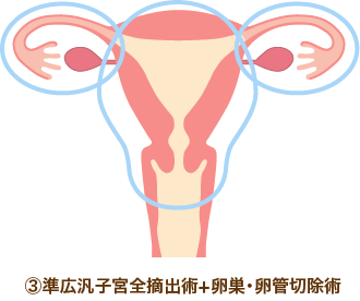 広汎子宮全摘出術