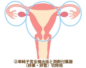 ②単純子宮全摘出術＋両側付属器（卵巣・卵管）切除術