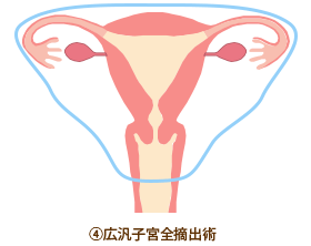 ④広汎子宮全摘出術