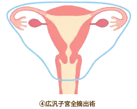 ④広汎子宮全摘出術