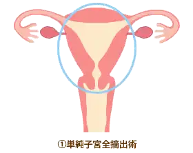 ①単純子宮全摘出術