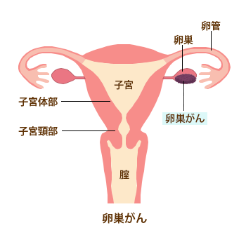 ん 初期 症状 卵巣 が おなかがふくれてきたら…卵巣がん検診で確認を：朝日新聞デジタル
