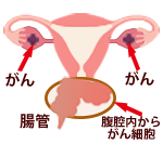 卵巣がん 産婦人科 新百合ヶ丘総合病院