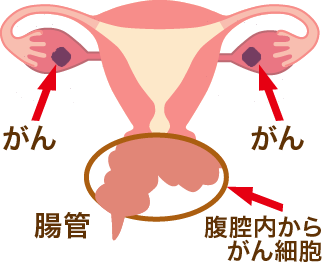 ステージ4