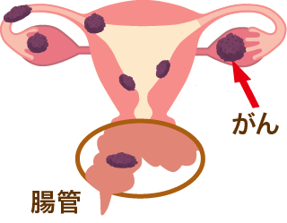 ステージ4
