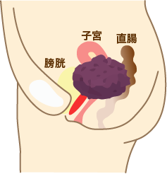 ステージ4a