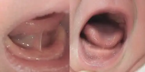 上唇小帯短縮症写真