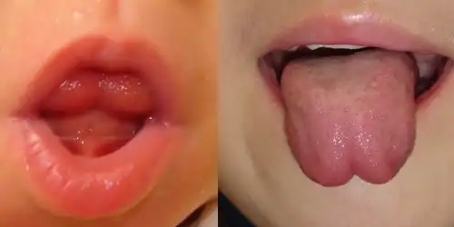 舌小帯短縮症写真