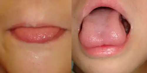 舌小帯短縮症写真