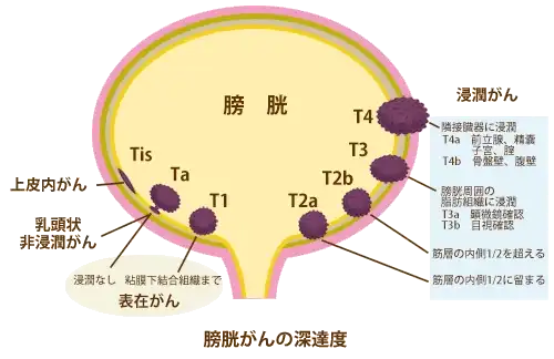 膀胱がんの病期