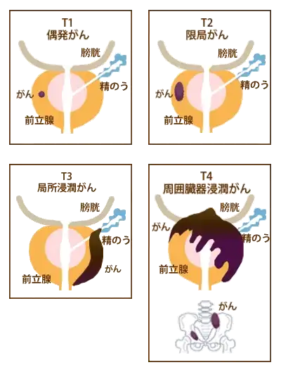 前立腺がんの病期