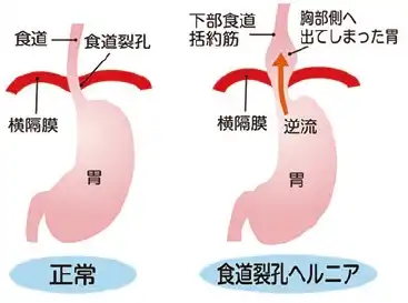 生活習慣病としての咽喉頭酸逆流症