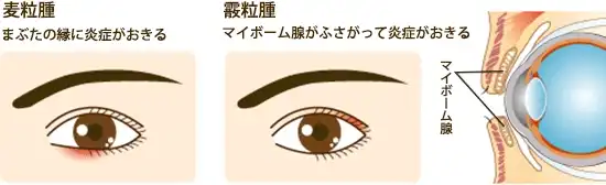 麦粒腫・霰粒腫の症状