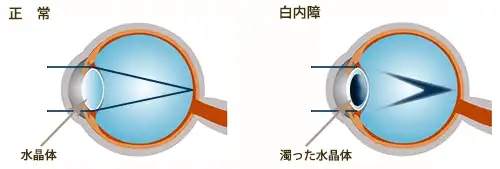 白内障の症状