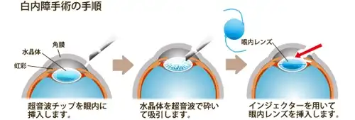白内障の手術の手順