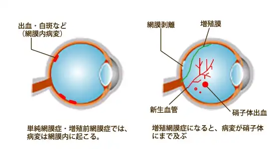 糖尿病網膜症