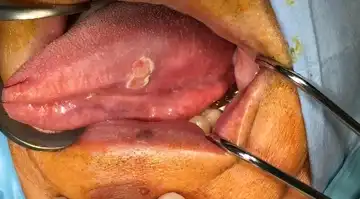 口腔腫瘍