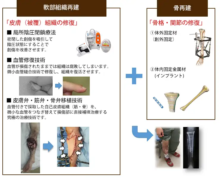 重度四肢外傷再建術とは？