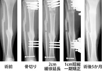 緩徐延長 ＋ 一期矯正術