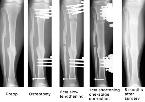 Slow extension ＋ First-stage orthodontics