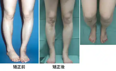 緩徐延長 ＋ 一期矯正術