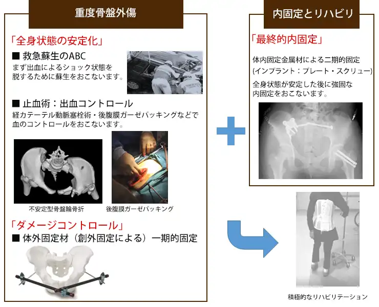 多発外傷・骨盤骨折とは？