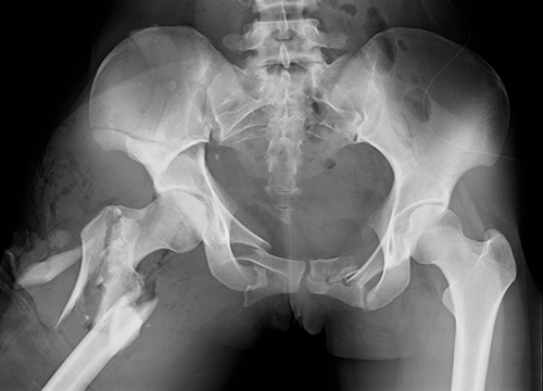 Pelvic ring fracture